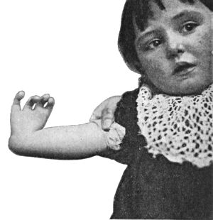 Fig. 171.—Club-hand, the result of imperfect
development of radius. The thumb is absent.