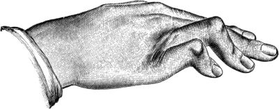 Fig. 172.—Congenital Contraction of Ring and Little
Fingers.