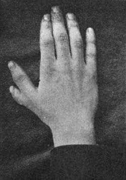 Fig. 175.—Supernumerary Thumb.