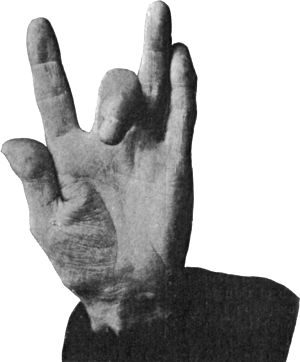 Fig. 176.—Trigger Finger.