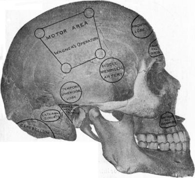 Fig. 182.—To illustrate the site of various operations
on the skull.