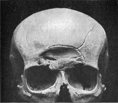 Fig. 188.—Depressed Fracture of Frontal
Bones—involving the air sinus on both sides—with a fissured fracture
radiating from it.