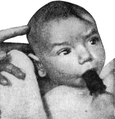 Fig. 190.—Pond Fracture of Left Frontal Bone, produced
during delivery.