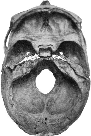 Fig. 191.—Transverse Fracture through Middle Fossa of
Base of Skull.