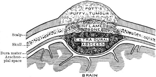 Fig. 192.—Diagram of Extra-Dural Abscess.