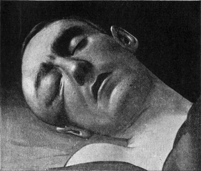 Fig. 193.—Pott's Puffy Tumour in case of extra-dural
abscess following compound fracture of orbital margin; infected with
road-dust; operation; recovery. At the time of the photograph the man
was unconscious.