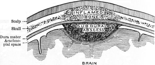 Fig. 194.—Diagram of Sub-Dural Abscess.