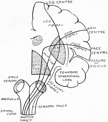 Fig. 195.—Diagram illustrating Sequence of Paralysis,
caused by abscess in temporal lobe. (After Macewen.)