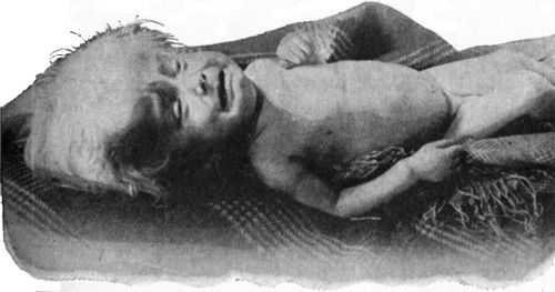 Fig. 200.—Hydrocephalus in a child æt. 3-1/2.