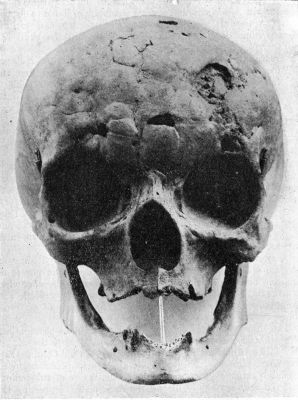 Fig. 202.—Skull of woman illustrating the appearances
of Tertiary Syphilis of Frontal Bone—Corona Veneris—in the healed
condition.