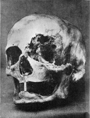 Fig. 204.—Destruction of Bones of Left Orbit, caused
by Rodent Cancer. The patient died of septic meningitis.