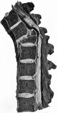Fig. 208.—Fracture—Dislocation of Ninth Thoracic
Vertebra, showing downward and forward displacement of upper segment,
and compression of cord by upper edge of lower segment.