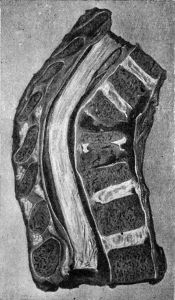 Fig. 210.—Tuberculous Osteomyelitis affecting several
vertebræ at Thoracico-lumbar Junction.