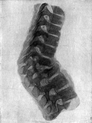 Fig. 212.—Radiogram of Museum Specimen of Pott's
disease in a Child; the disease is located at the thoracico-lumbar
junction.