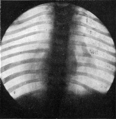 Fig. 213.—Radiogram of Child's Thorax, showing
spindle-shaped shadow at site of Pott's disease of fourth, fifth, and
sixth thoracic vertebræ.