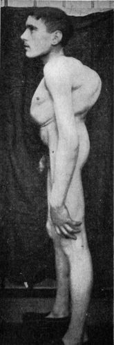 Fig. 216.—Hunch-back Deformity following Pott's
disease of Thoracic Vertebræ.