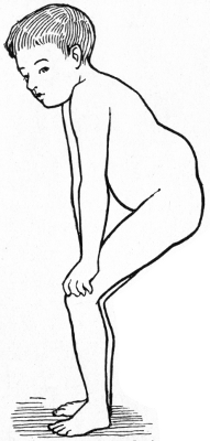 Fig. 217.—Attitude in Pott's disease of
Thoracico-lumbar Region of Spine.