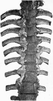 Fig. 218.—Arthritis Deformans of Spine. The vertebræ
are fixed to one another by outgrowths of bone which bridge across the
intervertebral spaces, and there is a slight lateral deviation to the
left in the mid-dorsal region.
