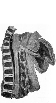 Fig. 220.—Meningo-myelocele of Cervical Spine.