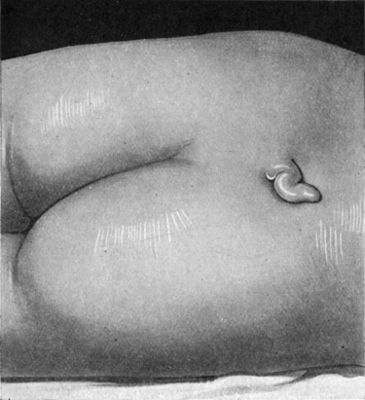 Fig. 222.—Tail-like Appendage over Spina Bifida
Occulta in a boy æt. 5, and associated with incontinence of urine.
Operation was followed by temporary retention.