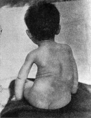 Fig. 225.—Rickety Scoliosis in a child æt. 2.