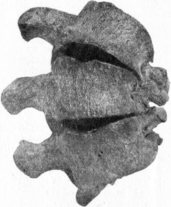 Fig. 226.—Vertebræ from case of Scoliosis, showing
alteration in shape of bones.