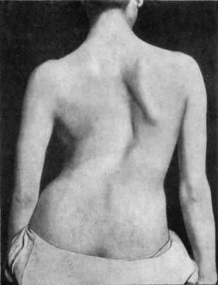 Fig. 227.—Adolescent Scoliosis in a girl æt. 23.
