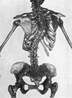 Fig. 228.—Scoliosis with primary curve in Thoracic
Region.