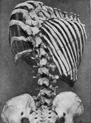 Fig. 229.—Scoliosis showing rotation of bodies of
vertebræ, and widening of intercostal spaces on side of convexity.