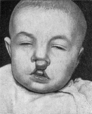 Fig. 235.—Double Hare-lip with Projection of Os
Incisivum, in an infant before first dentition.