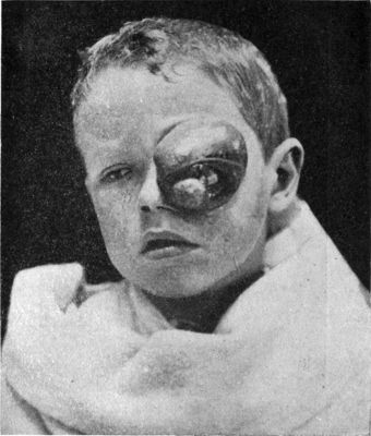 Fig. 239.—Sarcoma of Eyelid in a child.