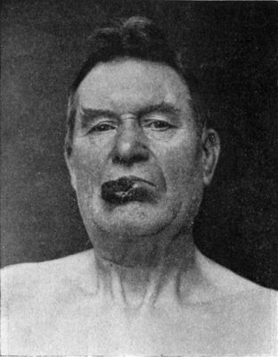 Fig. 242.—Squamous Epithelioma of Lower Lip in a man
æt. 55.