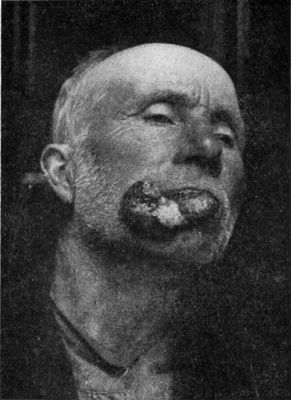 Fig. 243.—Advanced Epithelioma of Lower Lip.