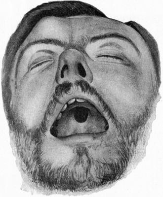 Fig. 246.—Perforation of Palate, the result of
Syphilis, and Gumma of Right Frontal Bone.