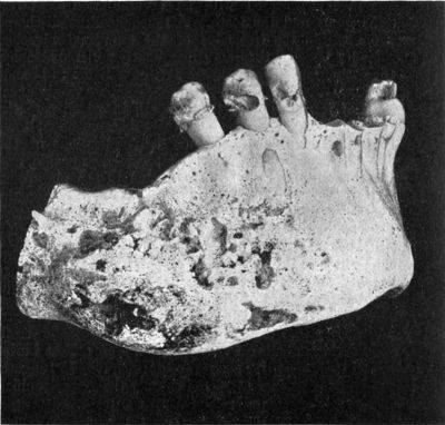 Fig. 247.—Cario-necrosis of Mandible.