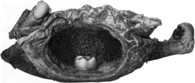 Fig. 252.—Dentigerous Cyst of Mandible containing
rudimentary tooth.