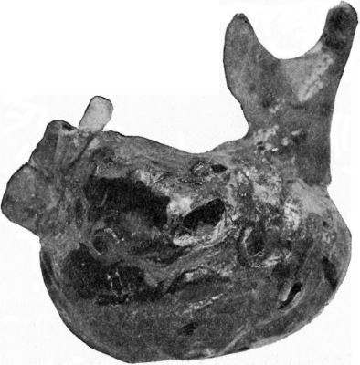 Fig. 253.—Osseous Shell of Myeloma of Mandible.