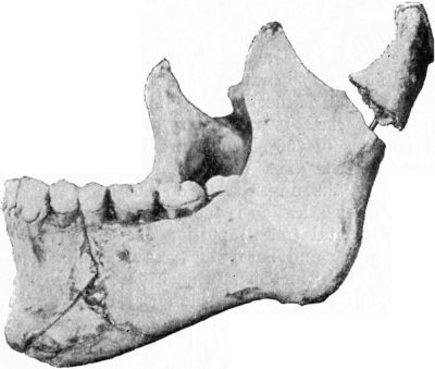 Fig. 254.—Multiple Fracture of Mandible.