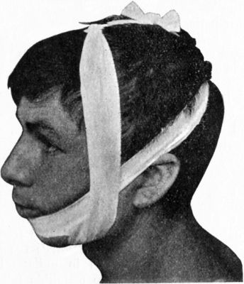 Fig. 255.—Four-tailed Bandage applied for Fracture of
Mandible.