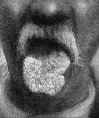 Fig. 257.—Leucoplakia of the Tongue.