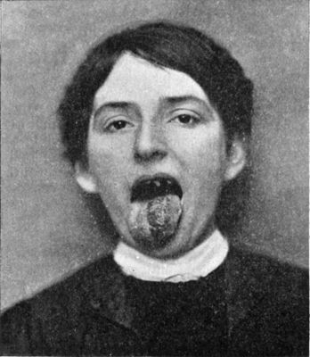Fig. 258.—Papillomatous Angioma of left side of tongue
in a woman aged 26.