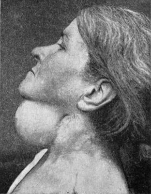 Fig. 259.—Dermoid Cyst in middle line of neck.