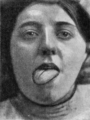Fig. 260.—Temporary Unilateral Paralysis of Tongue,
from bruising of hypoglossal nerve during operation for tuberculous
cervical glands.