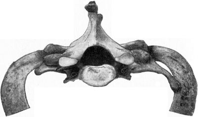 Fig. 269.—Bilateral Cervical Ribs; the left one is the
better developed.