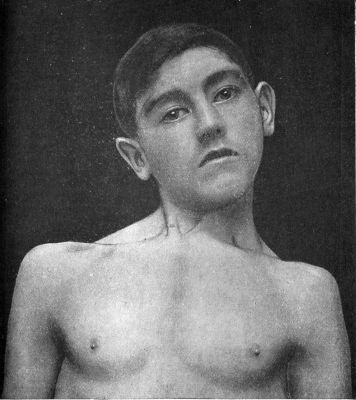 Fig. 271.—Congenital Wry-neck in a boy æt. 14.