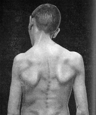 Fig. 272.—Congenital Wry-neck seen from behind to show
scoliosis.