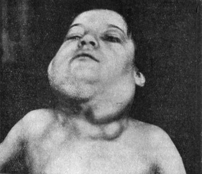 Fig. 275.—Lympho-sarcoma of Neck.