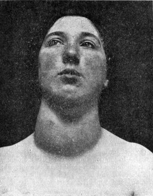 Fig. 277.—Parenchymatous Goitre in a girl æt. 15.