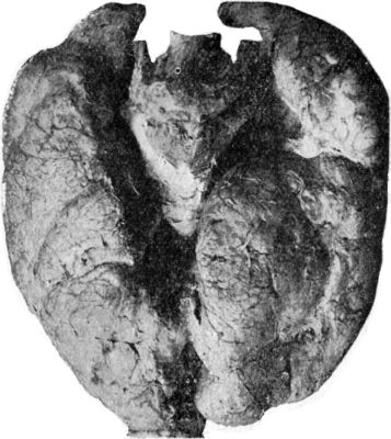 Fig. 278.—Larynx and Trachea surrounded by Goitre.
