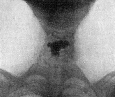 Fig. 284.—Denture impacted in Œsophagus.